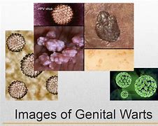 Image result for genital warts cause
