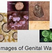 Image result for Mild Female Genital Warts