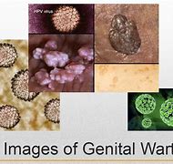 Image result for Filiform Genital Wart