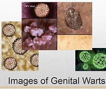 Image result for Signs of Genital Warts in Women
