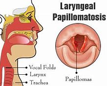 Image result for Papilloma in Mouth