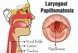 Image result for Papilloma in Mouth