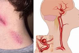 Image result for Hickey On His Neck