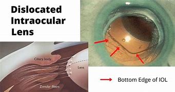 Image result for Intraocular Lens Surgery