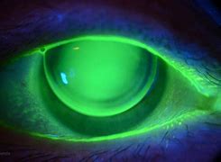 Image result for Cylinder Toric Contact Lens