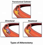 Image result for Atherectomy