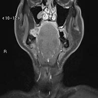 Image result for 2 Cm Tumor Retromolar Trigone