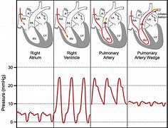 Image result for Cardiac Wedge Pressure