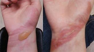 Image result for 1st Degree Burn Treatment