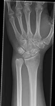 Image result for Tumor in Wrist X-ray