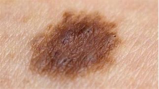 Image result for Mole On Arm