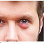 Image result for Common Eye Infections