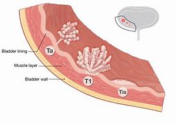 Image result for How Big Is 5 mm Tumor