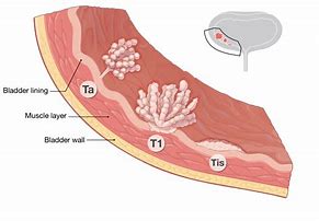 Image result for How Big Is 6Mm Tumor