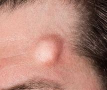 Image result for hematoma