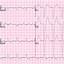 Image result for Left Bundle Branch Block