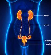 Image result for Female Kidney Stones