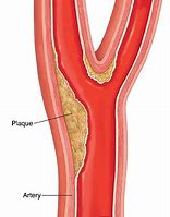 Image result for Carotid Artery Plaque