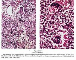 Image result for Stage IV Dysgerminoma