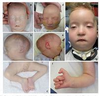 Image result for Craniosynostosis