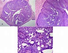 Image result for Subungual Papilloma