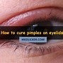 Image result for Stye or Pimple On Eyelid