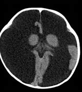 Image result for Hydrancephaly MRI