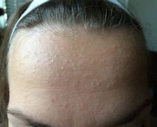 Image result for Small Acne Bumps On Face
