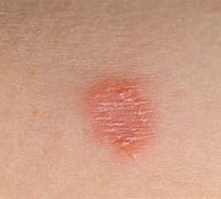 Image result for Ringworm around Mouth