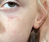 Image result for Urticaria On Face