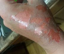 Image result for 2nd Degree Chemical Burn