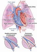 Image result for Pulmonary Heart Disease