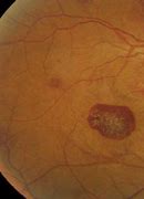 Image result for Leukemia Eyes