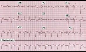 Image result for EKG Interpretation