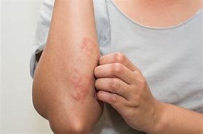 Image result for eczema