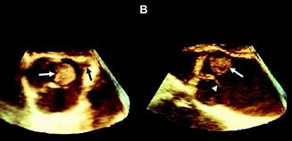 Image result for Papillary Fibroelastoma