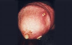Image result for gonorrhée