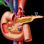 Image result for Tumor On Pancreas