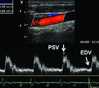 Image result for Carotid Ultrasound Velocities