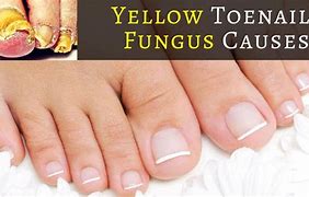 Image result for Yellow Toenail-Fungus