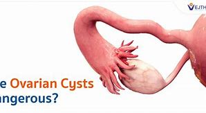 Image result for Bilateral Ovarian Cysts Simple Multiple