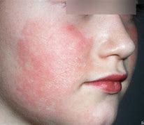 Image result for Slap Cheek Fifth Disease