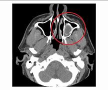 Image result for Maxillary Sinus Polyp CT