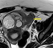 Image result for Ovarian Dermoid Cyst 10Cm