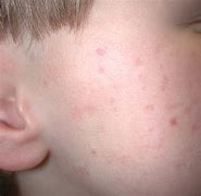 Image result for Keratosis Pilaris Treatment for Kids
