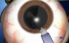 Image result for Laser Cataract Animation
