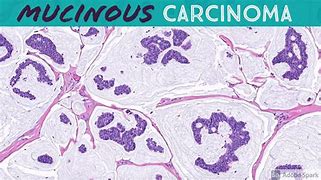 Image result for Mucinous Carcinoma Symptoms