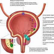 Image result for Small Cell Carcinoma Bladder Cancer