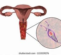 Image result for Trichomoniasis Female