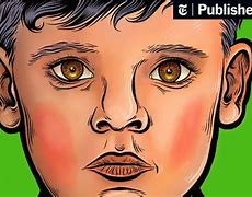 Image result for Fifth Disease Rash Face